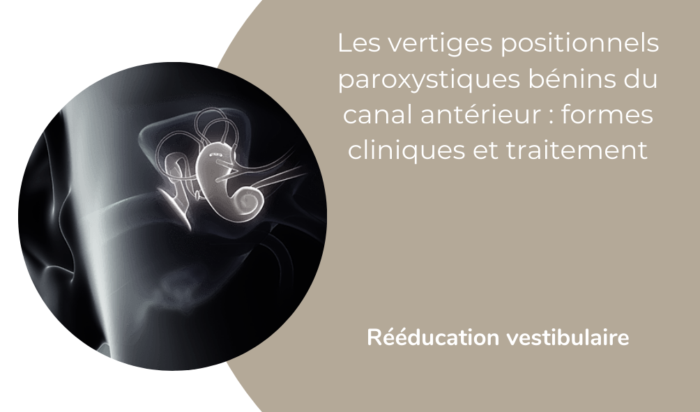 Les vertiges positionnels paroxystiques bénins du canal antérieur : formes cliniques et traitement